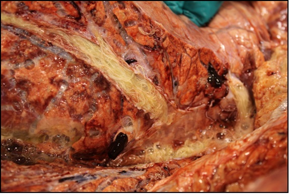 Lungworm in airways of 30 month old heifer