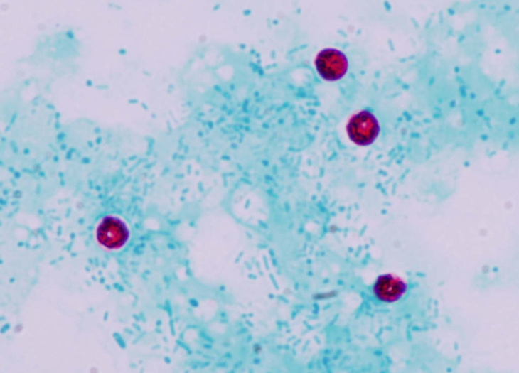 Cryptosporidial Oocysts in a faecal smear