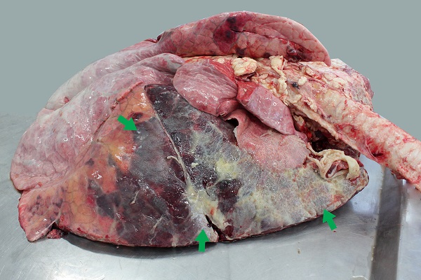 Fibirnous Bronchopneumonia image